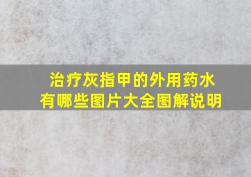 治疗灰指甲的外用药水有哪些图片大全图解说明