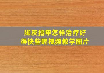 脚灰指甲怎样治疗好得快些呢视频教学图片