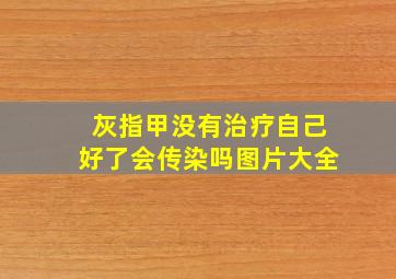 灰指甲没有治疗自己好了会传染吗图片大全