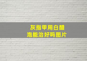 灰指甲用白醋泡能治好吗图片